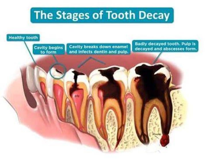 Can tooth decay cause health problems?