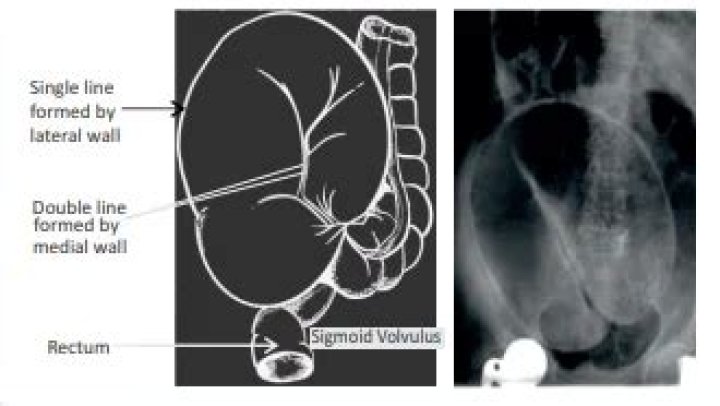 Can you see volvulus on x ray?