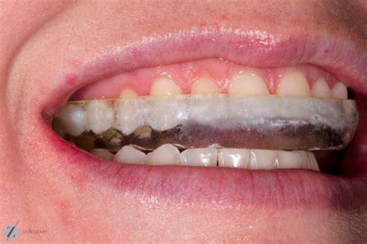 Could i be allergic to my night guard?