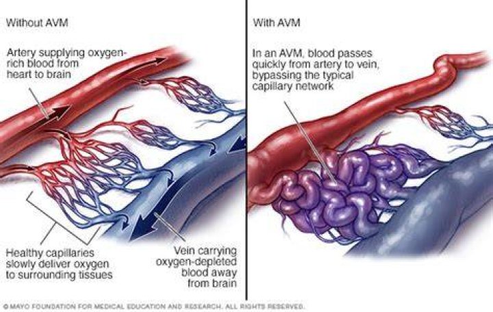 Do avm run in families?