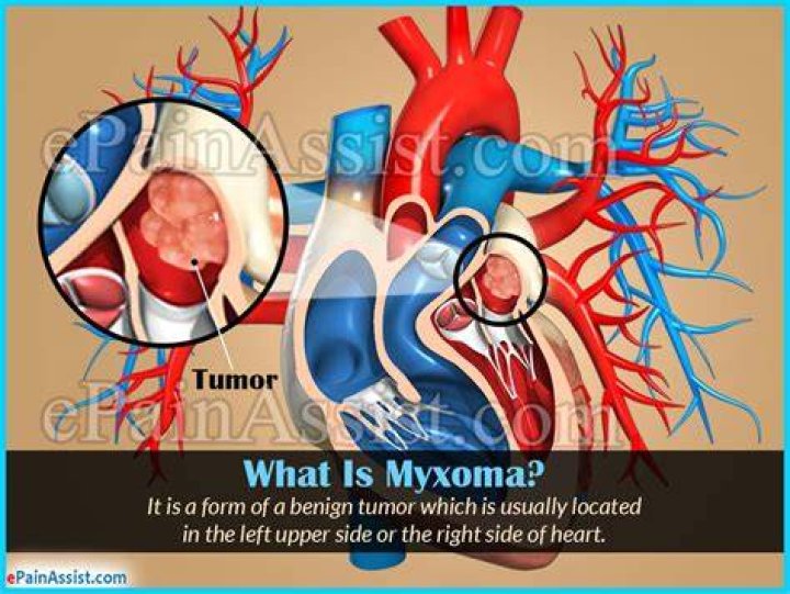 Does atrial myxoma cause chest pain?