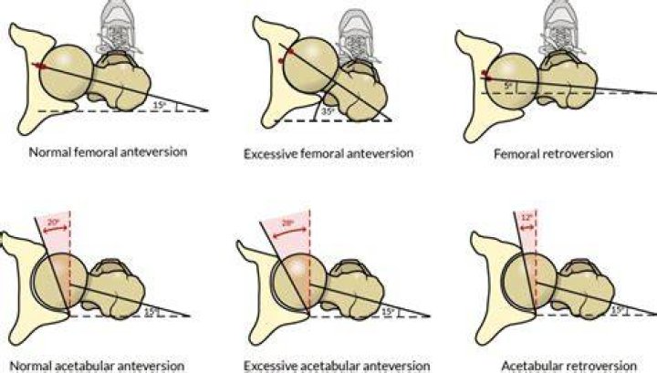 How to fix hip retroversion?