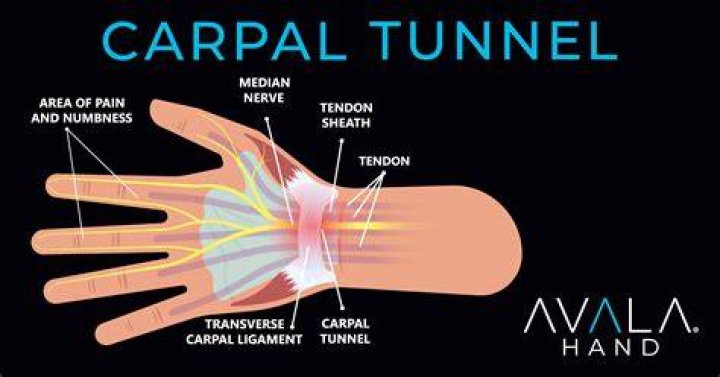 Where does it hurt if u have carpal tunnel?